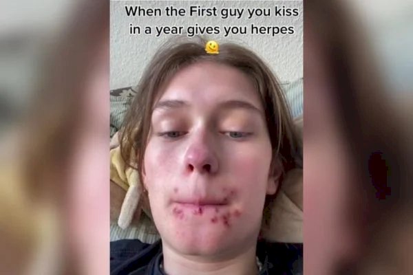 Mulher beija na boca pela primeira vez em um ano e pega herpes grave
