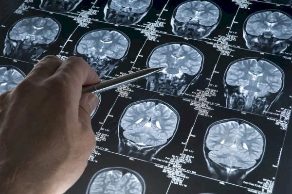 Alzheimer pode ser doença autoimune do cérebro, sugere pesquisador