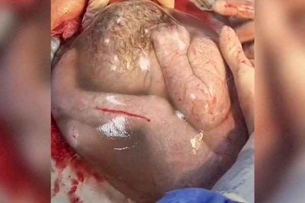 Médica compartilha vídeo em que gêmea nasce empelicada: “Mágico”