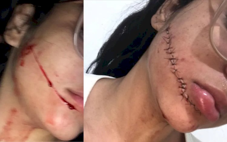 Pai da jovem que teve rosto cortado enquanto dormia em viagem de ônibus na BA pede justiça: 'pode ser fatal'