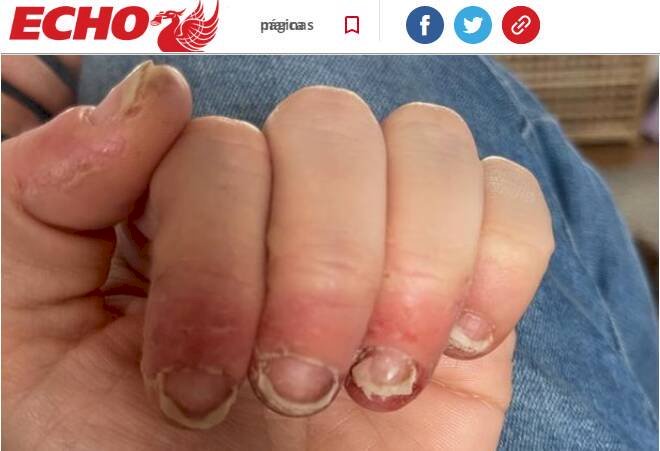 Após reação alérgica às unhas de gel, mulher fica sem conseguir mexer as mãos: 'Tremo de dor'