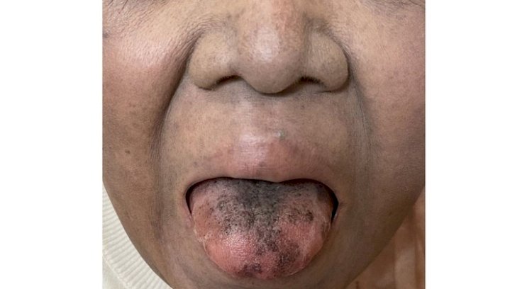 Mulher fica com a língua escura e peluda após tomar antibiótico